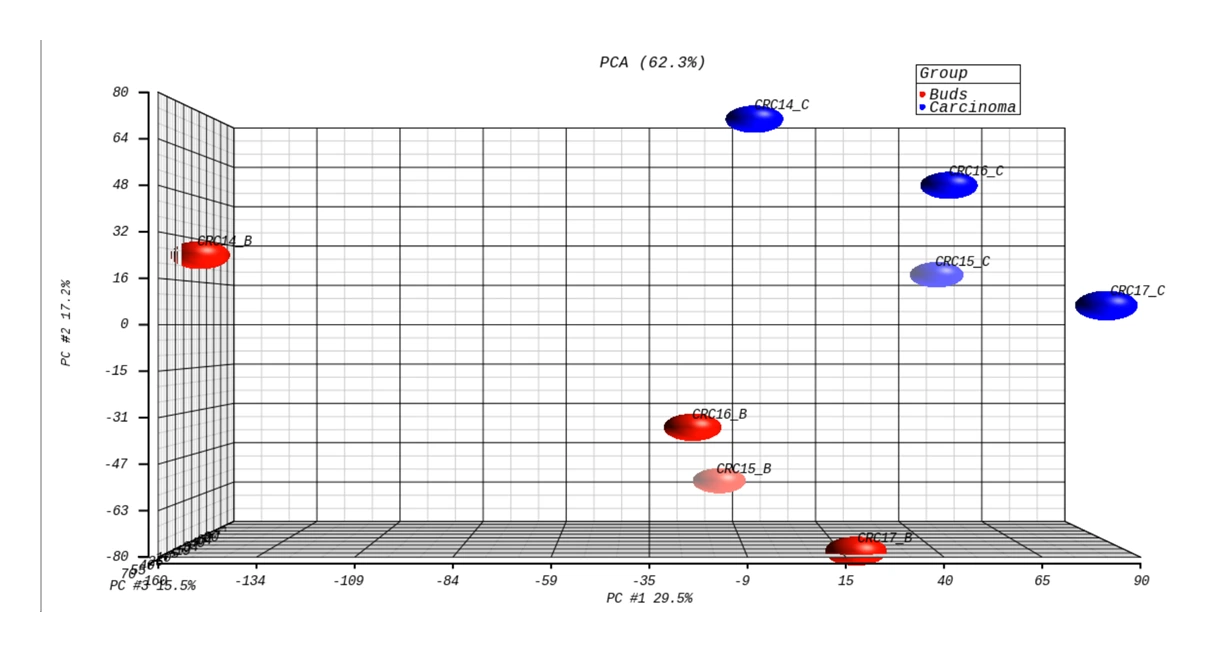 Three-dimensional PCA plot of transcriptomic profiles from four colorectal cancer samples (CRC14–CRC17). Tumor-bud regions (red) and carcinoma regions (blue) resolve into distinct clusters, showing region-specific expression differences. PC#1 explains 29.5% of variance, PC#2 17.2%, and PC#3 15.5%.