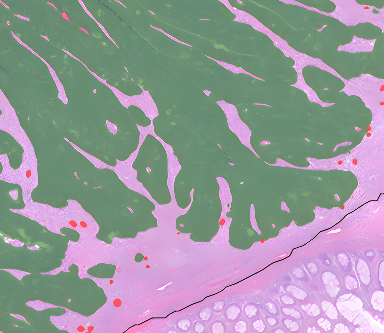 AI-annotated tissue with tumor regions highlighted