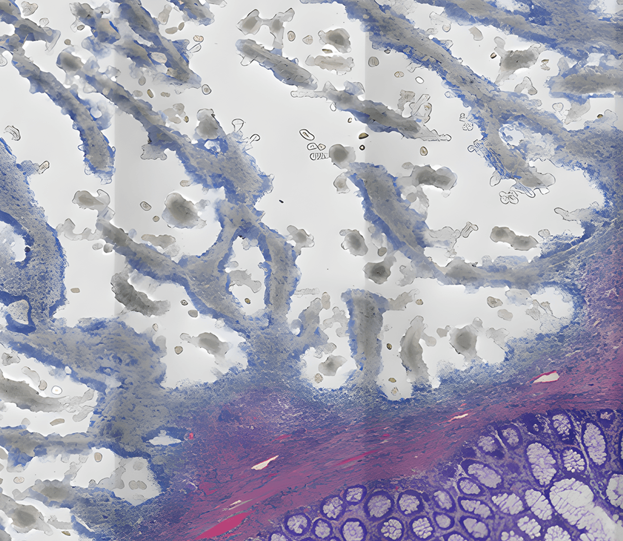Tissue after tumor extraction